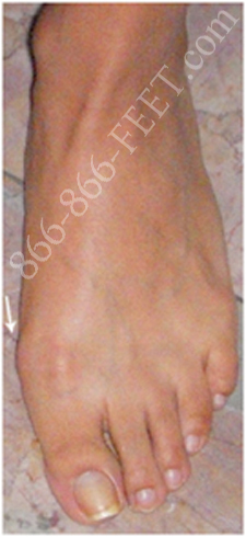 Bunion Before